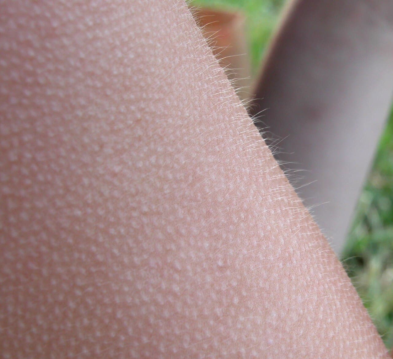 Close-up of a person's forearm covered in small raised bumps, with fine hairs standing up.